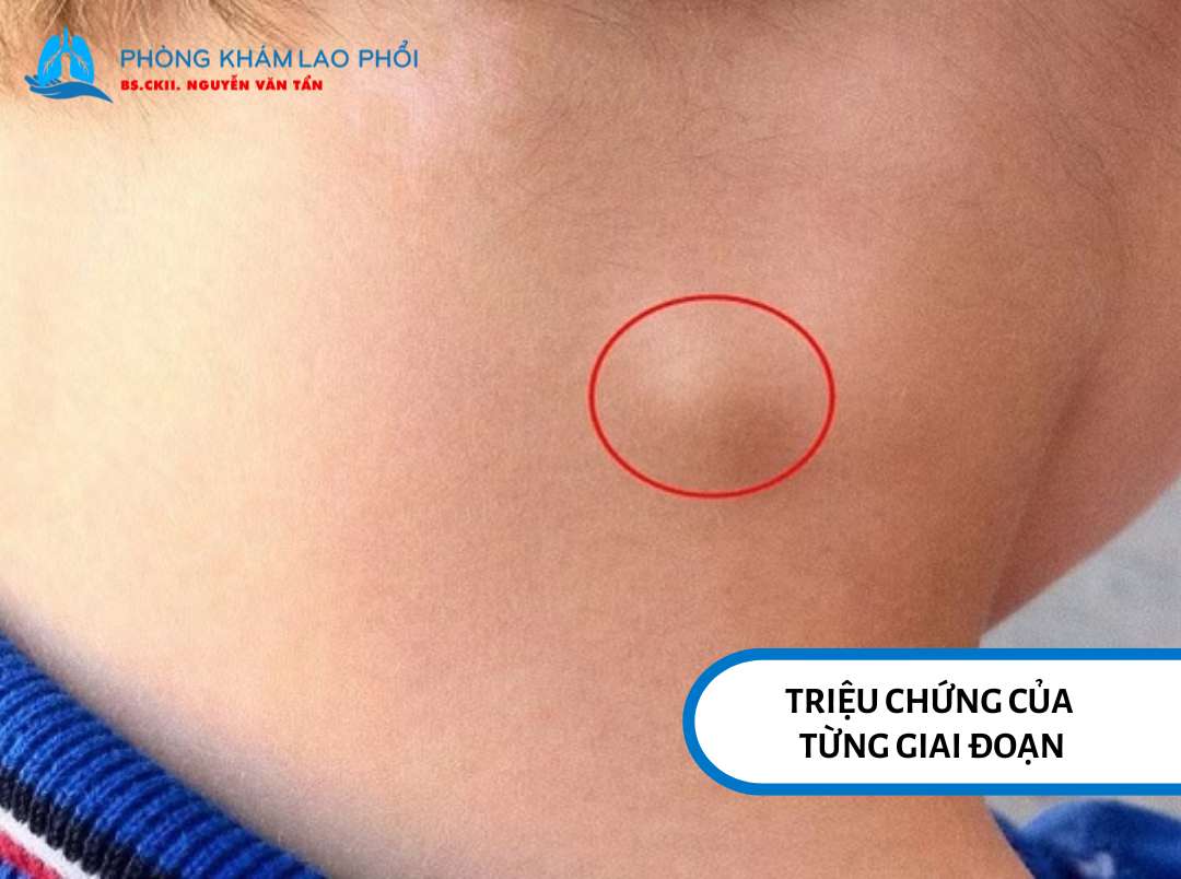 Các triệu chứng điển hình theo từng giai đoạn