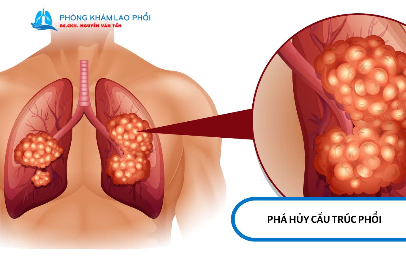 Lao phổi có thể gây biến chứng nặng nếu không điều trị kịp thời