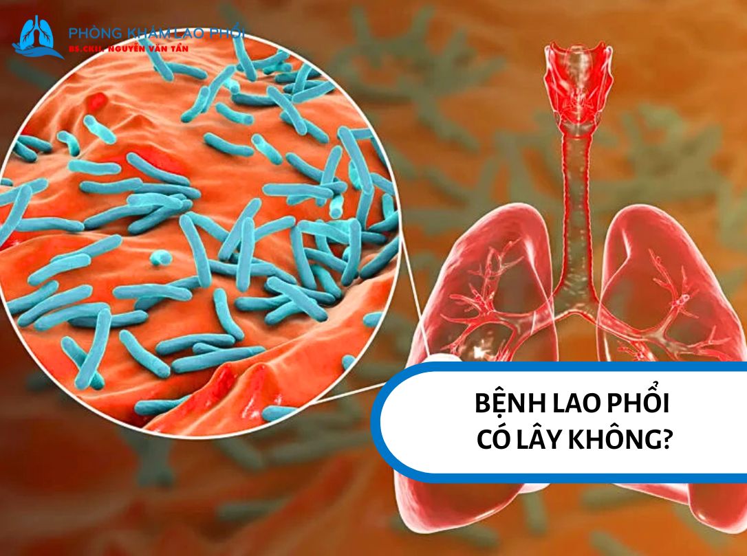 Vi khuẩn lao có thể mất khả năng gây bệnh dưới ánh nắng trực tiếp