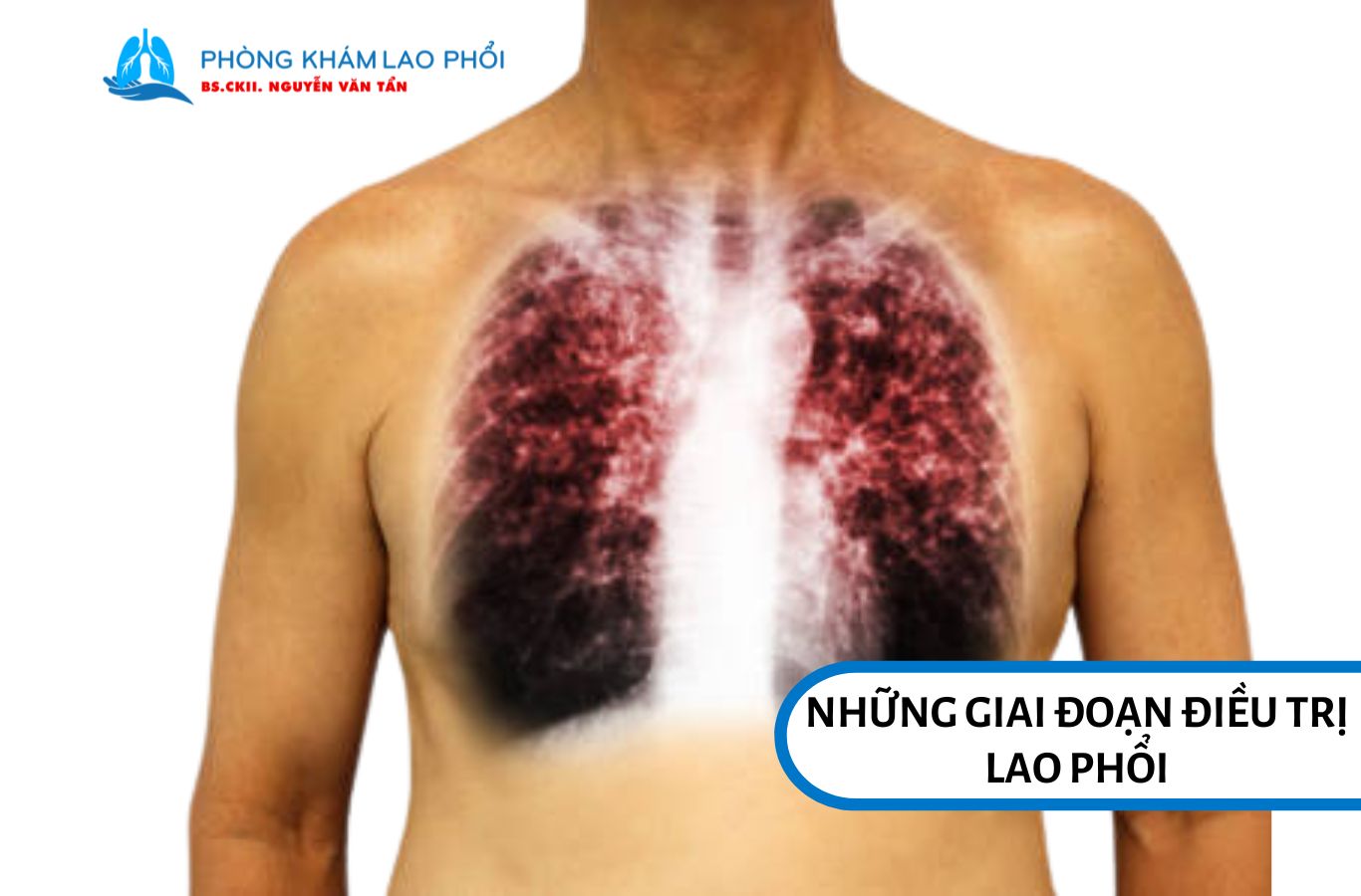 Giai đoạn đầu điều trị lao phổi nên hạn chế quan hệ 