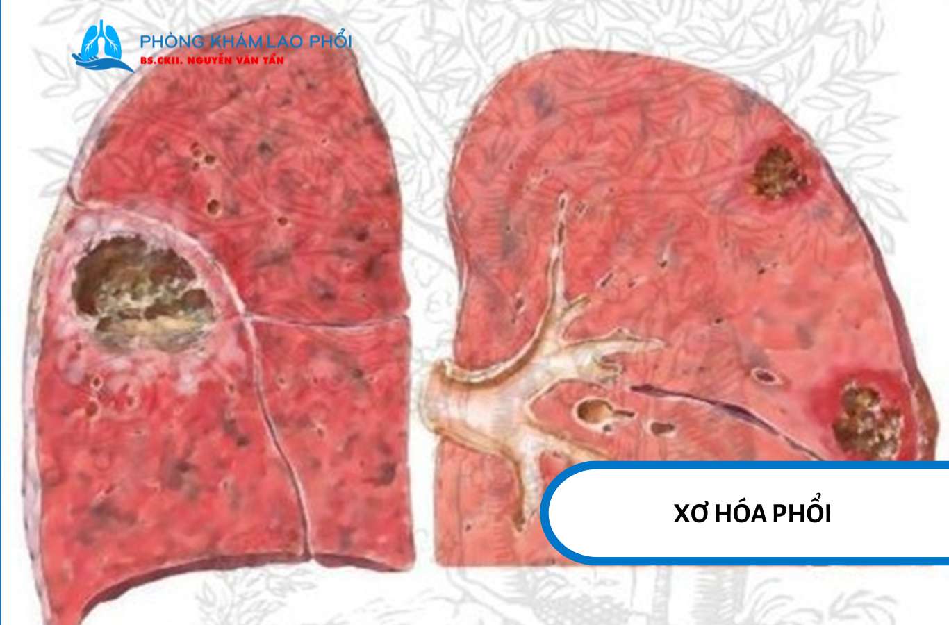 Xơ hóa phổi sau lao làm mô phổi cứng lại, giảm trao đổi khí và có thể gây suy hô hấp nặng