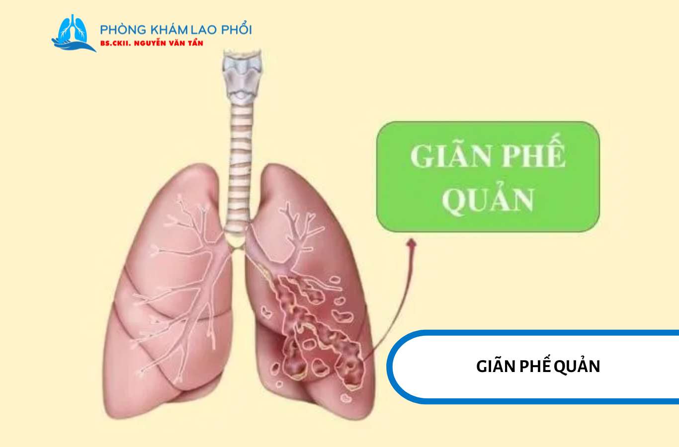 Giãn phế quản sau lao gây ho đờm mạn tính, dễ nhiễm trùng và có thể ho ra máu