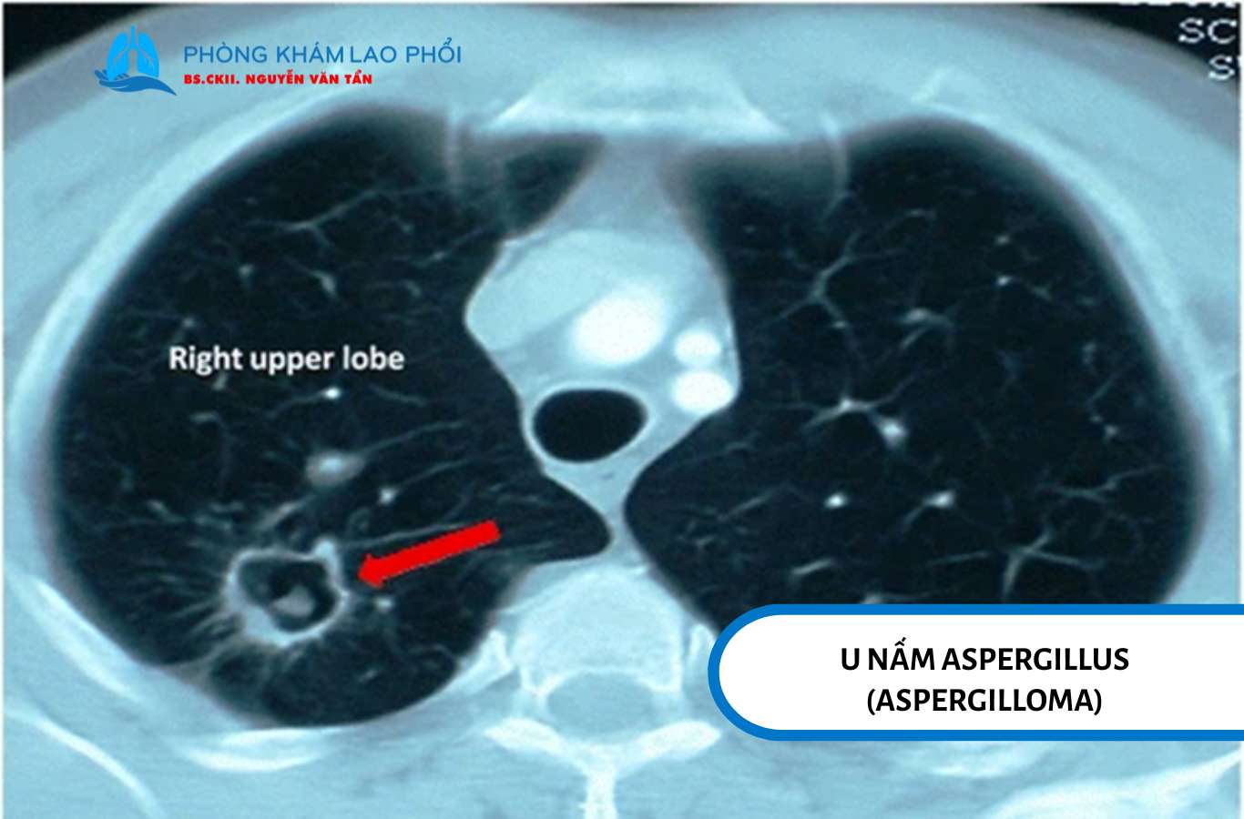 U nấm Aspergillus có thể hình thành trong hang lao cũ, gây ho ra máu và biến chứng nguy hiểm