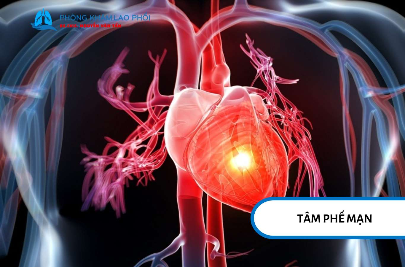 Tâm phế mạn là biến chứng nặng khi suy hô hấp kéo dài làm tim quá tải và dẫn đến suy tim
