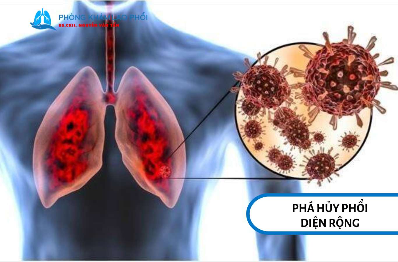 Lao không điều trị đúng có thể phá hủy phổi diện rộng và gây suy giảm chức năng hô hấp nghiêm trọng