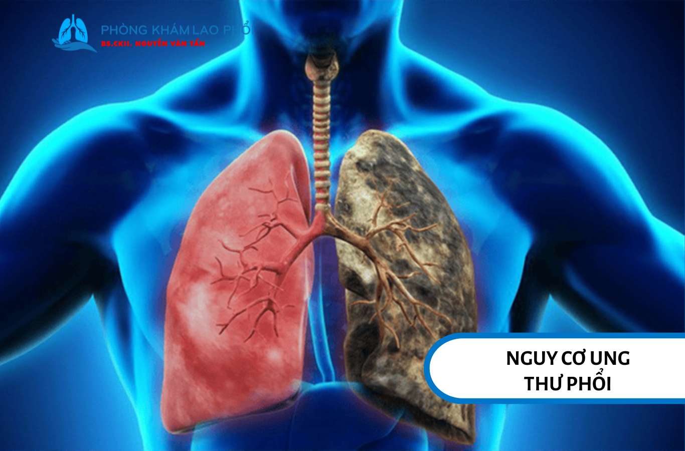 Tiền sử lao phổi có thể làm tăng nguy cơ ung thư phổi do viêm và xơ hóa kéo dài