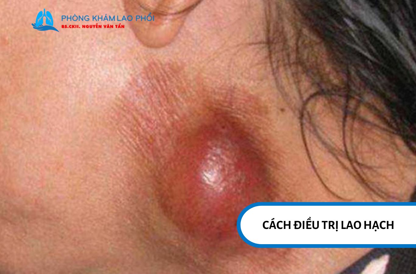 Điều trị lao hạch đúng phác đồ giúp kiểm soát bệnh và hạn chế biến chứng