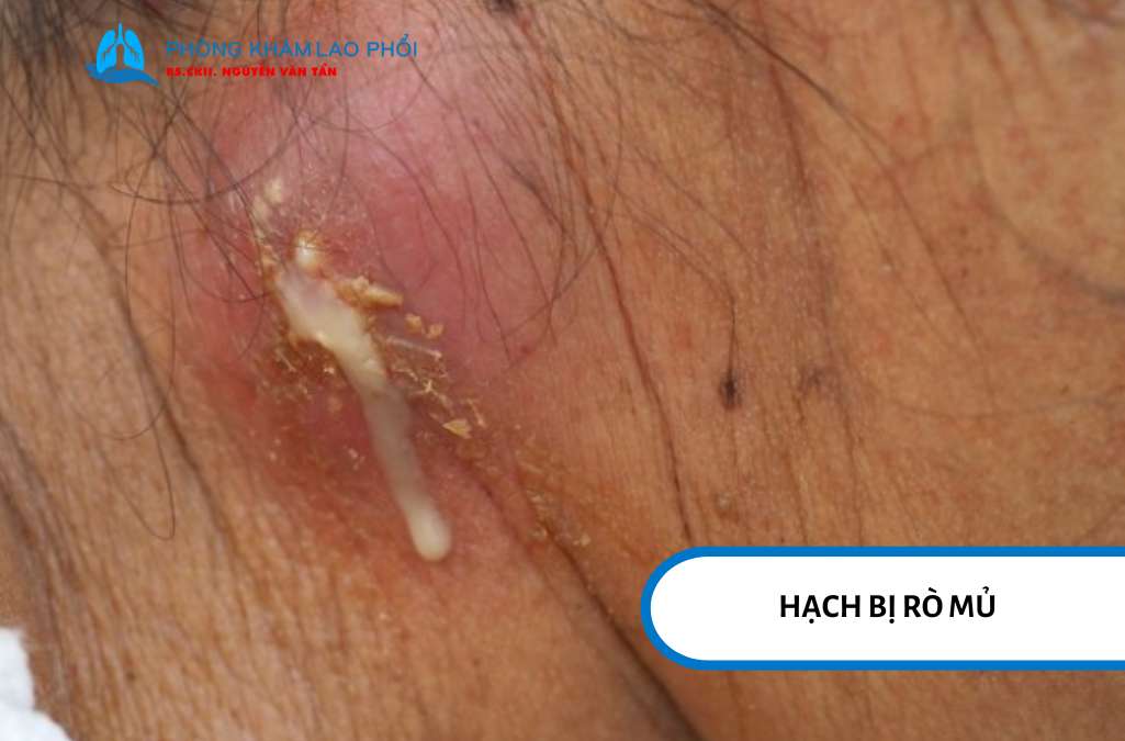Hạch bị rò mủ