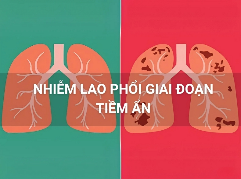 Nhiễm lao phổi tiềm ẩn