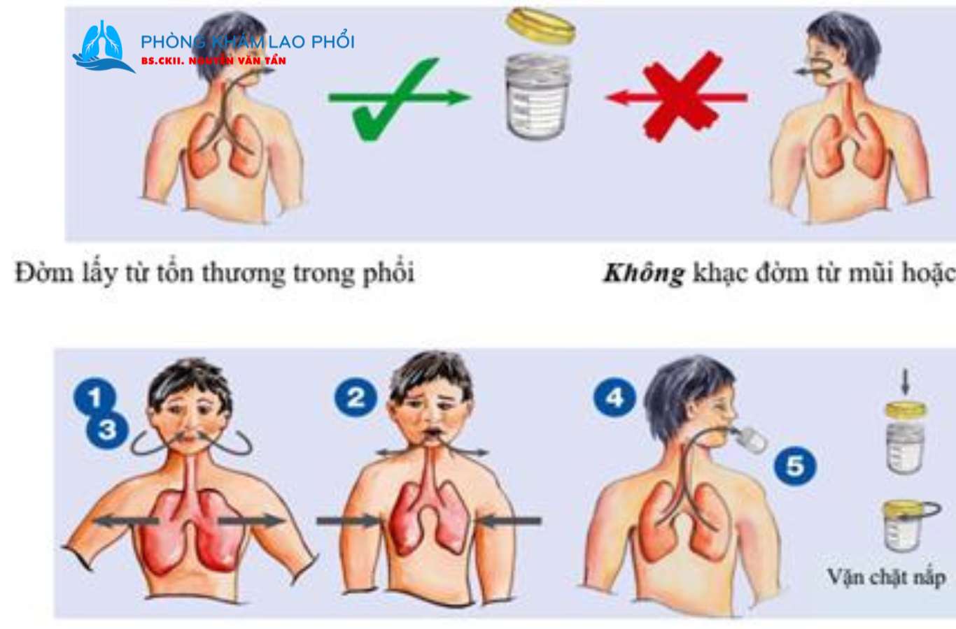 Cách khạc đờm để xét nghiệm tìm vi khuẩn lao