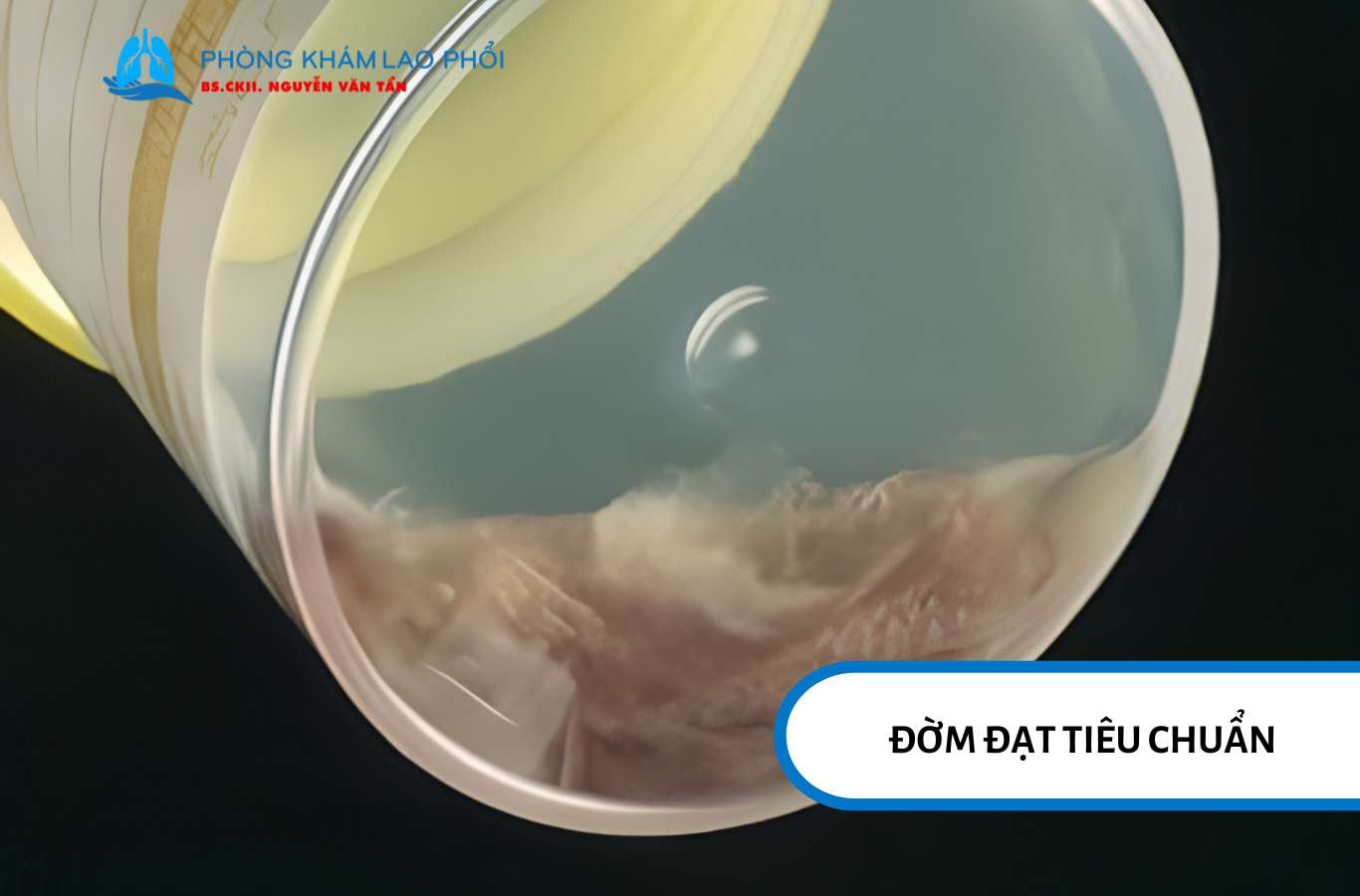Mẫu đờm đạt chuẩn phải lấy từ phổi, không lẫn nước bọt hay dịch mũi