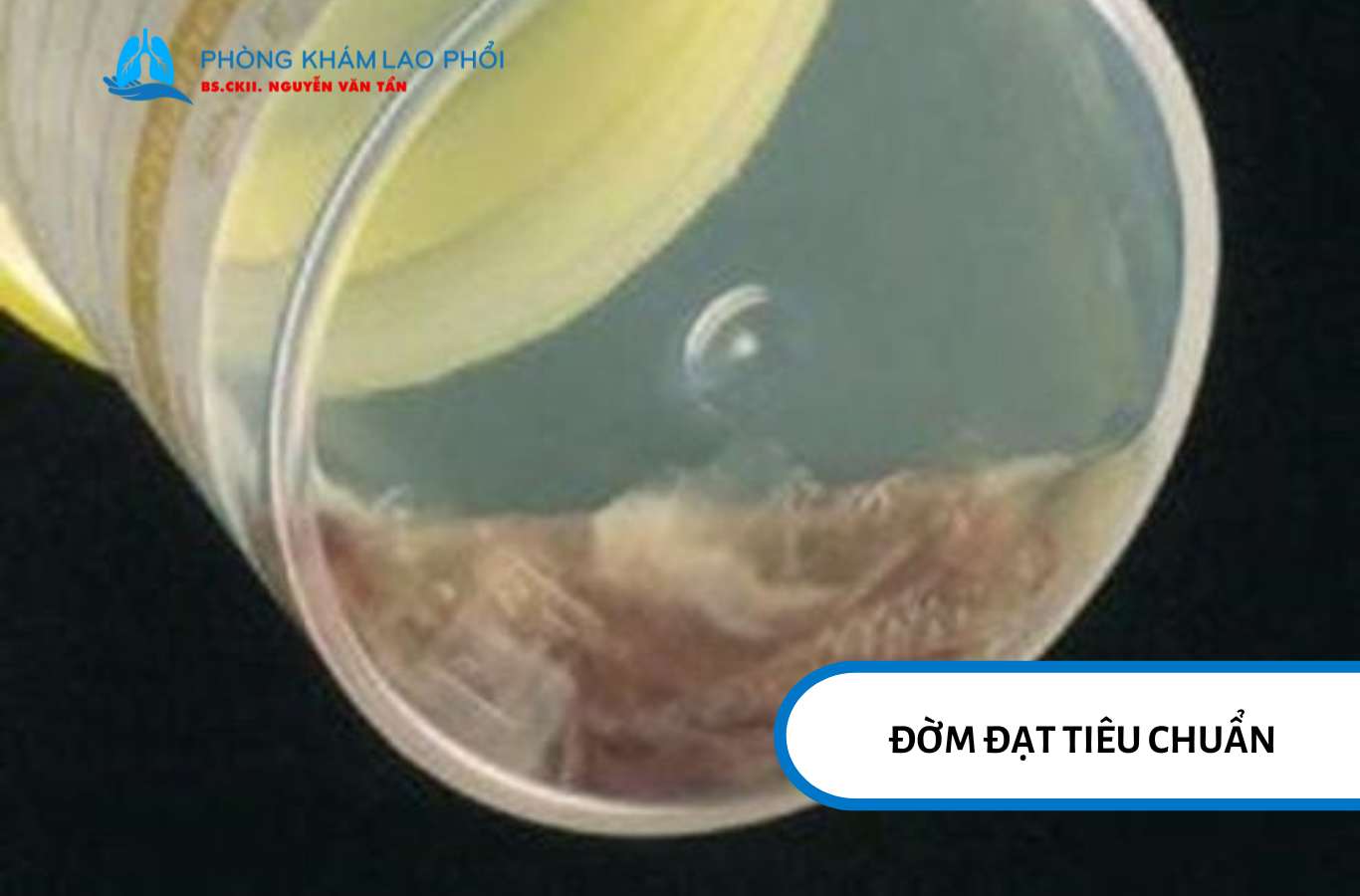 Mẫu đờm đạt chuẩn phải lấy từ phổi, không lẫn nước bọt hay dịch mũi