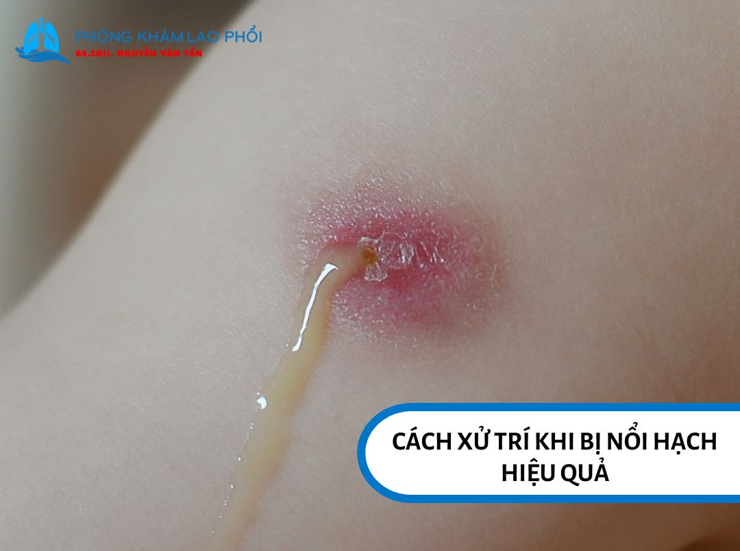 Sau tiêm vắc-xin lao, hạch bất thường cần khám chuyên sâu kịp thời