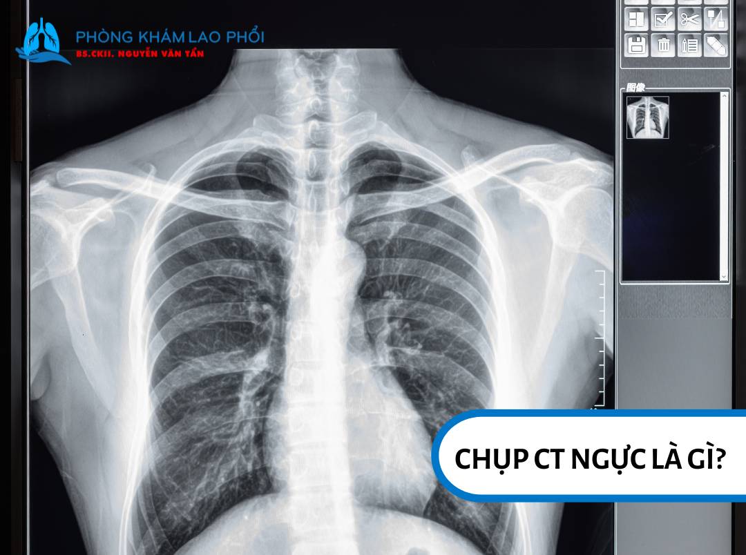 Chụp CT ngực là một phương pháp chẩn đoán hình ảnh hiện đại sử dụng tia X