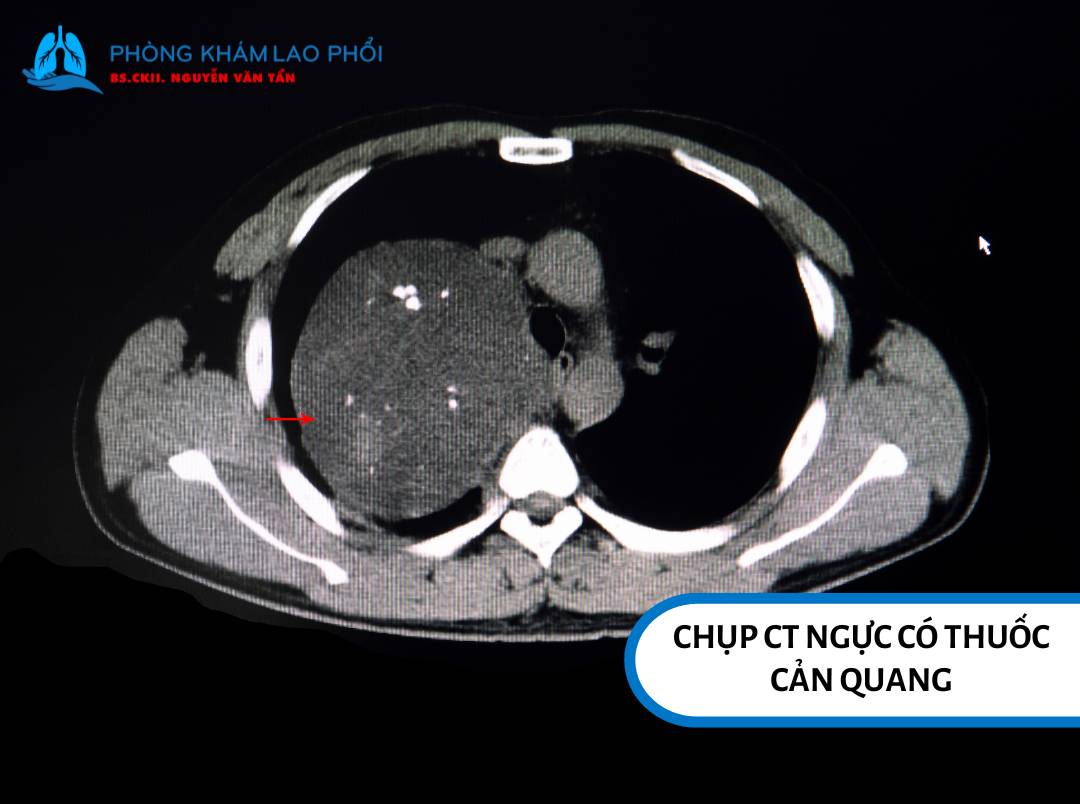 Chụp CT ngực có thuốc cản quang nhìn rõ hình ảnh mạch máu hay mô mềm