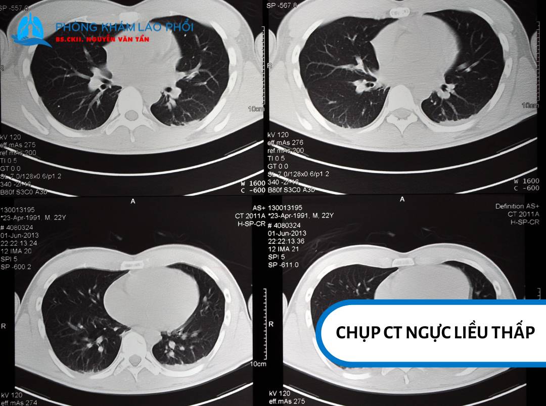 Chụp CT ngực liều thấp