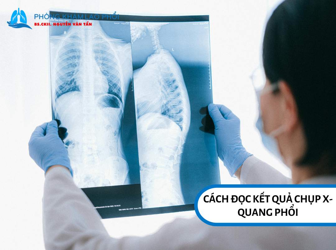 Cách đọc kết quả chụp X-quang phổi