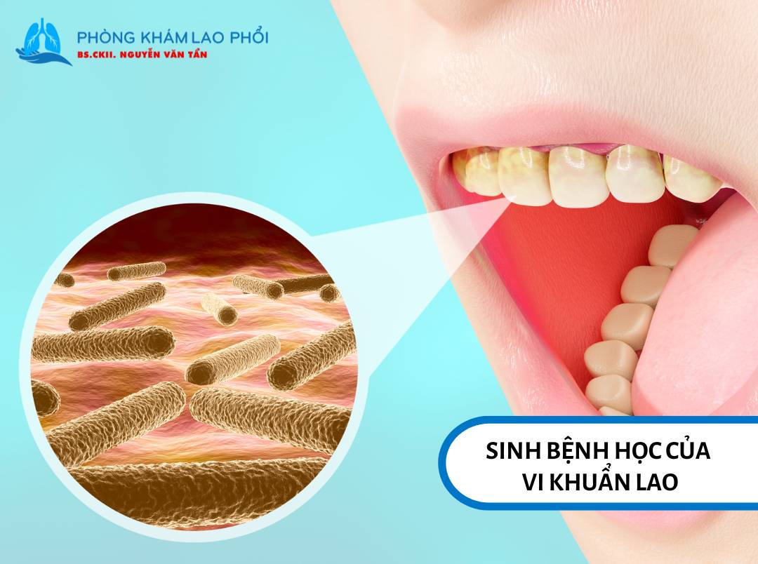 Vi khuẩn lao lây qua đường hô hấp