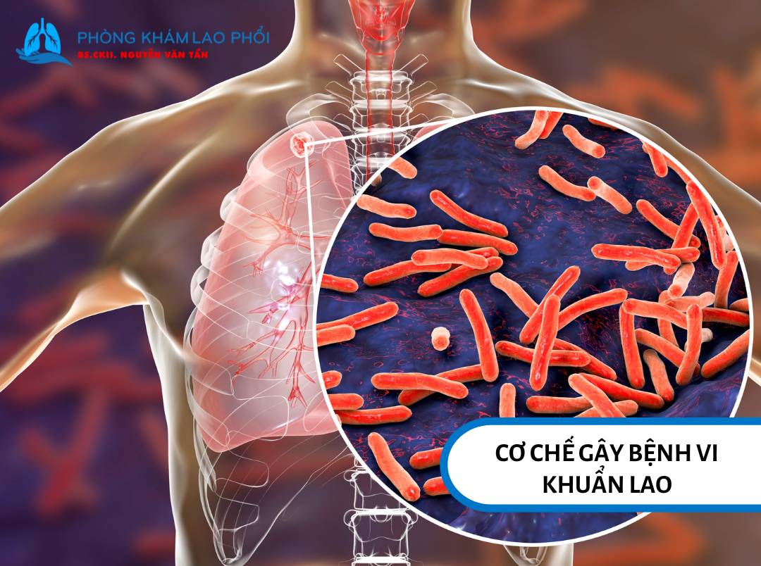 Vi khuẩn lao có khả năng chống lại sự tiêu diệt của đại thực bào