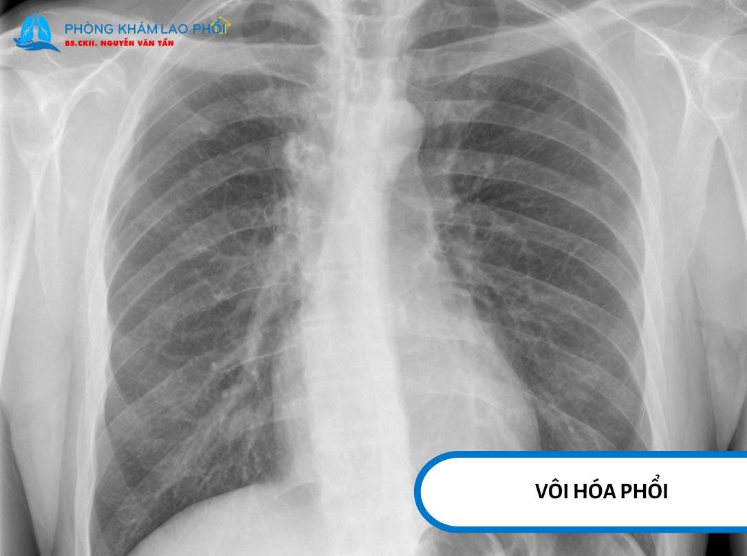 Tổn thương dạng nốt vôi hoá nhỏ ở phổi