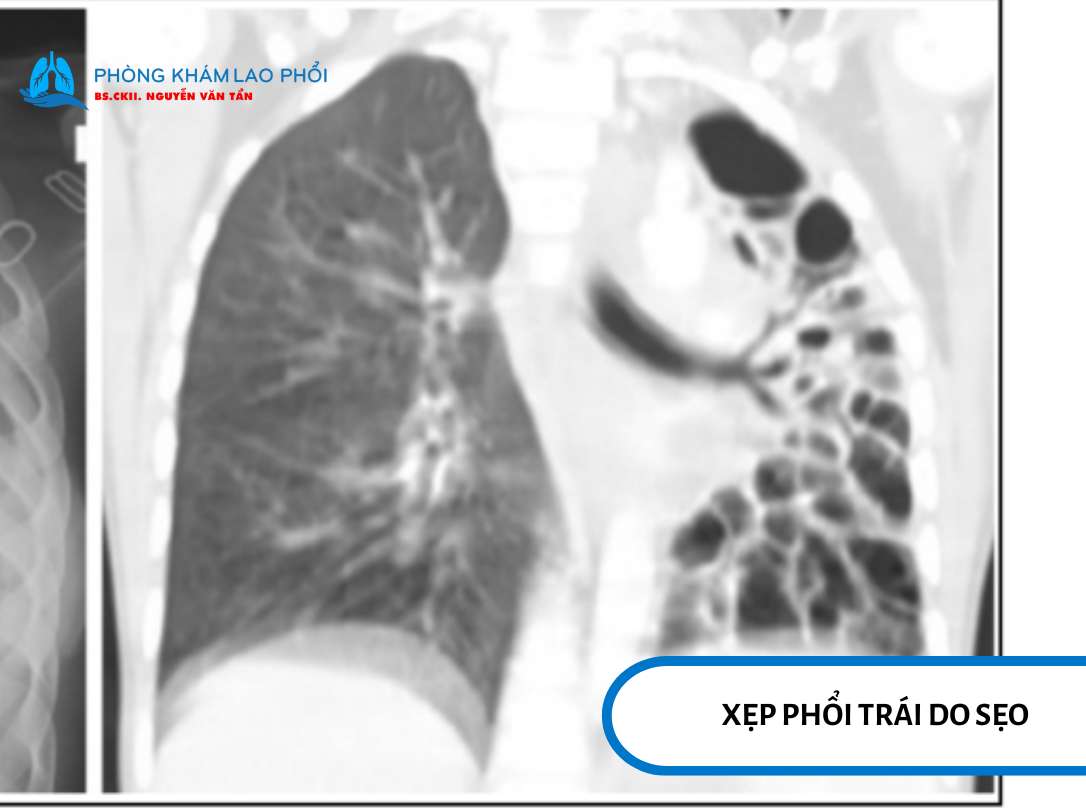 Xơ phổi là tình trạng tổn thương lâu dài do viêm và quá trình lành sẹo