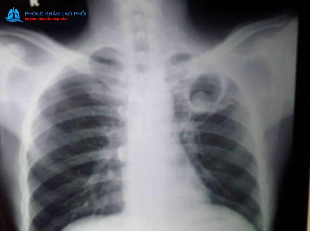 Hình ảnh U nấm phổi Aspergilloma