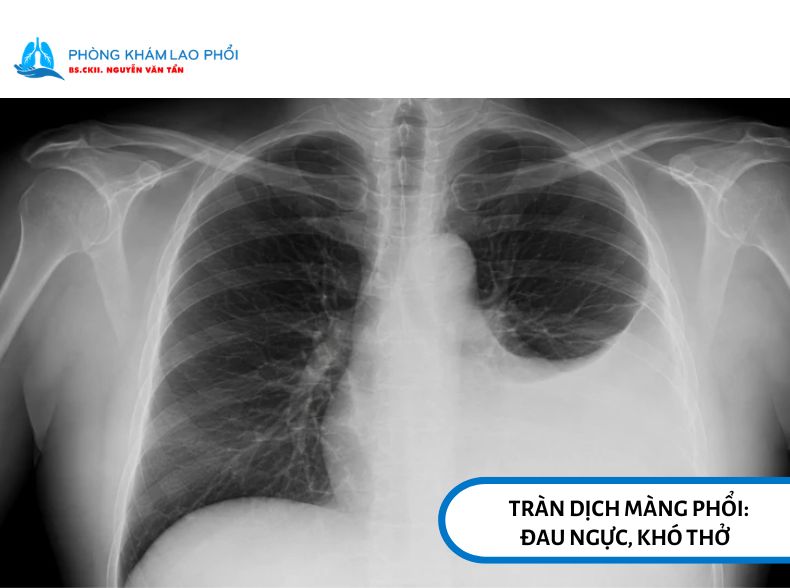 Tràn dịch màng phổi sau lao có thể chèn ép phổi, gây đau ngực và khó thở.