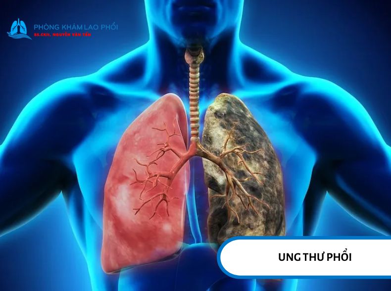 Viêm và xơ sẹo kéo dài có thể tạo điều kiện làm tăng nguy cơ ung thư phổi