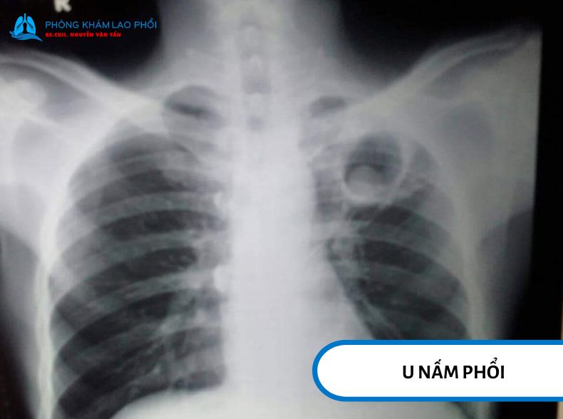 Hình ảnh U nấm phổi Aspergilloma