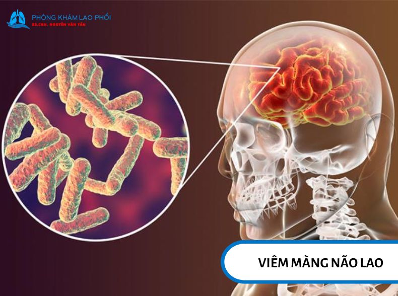 Viêm màng não lao có thể làm tăng áp lực nội sọ, gây rối loạn ý thức và tổn thương thần kinh