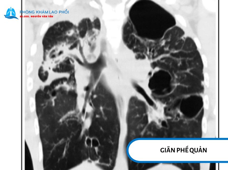 Giãn phế quản là tình trạng phế quản bị giãn rộng và không thể phục hồi