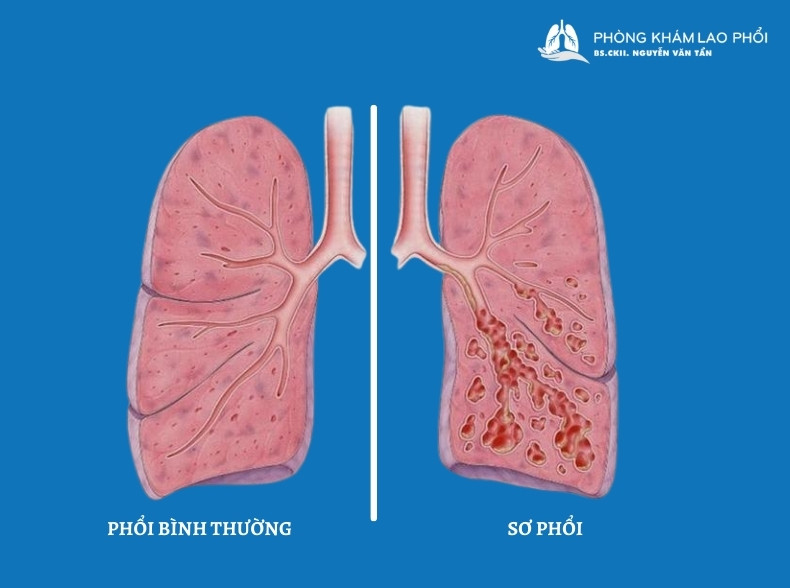 Xơ phổi là một tình trạng tổn thương mô phổ