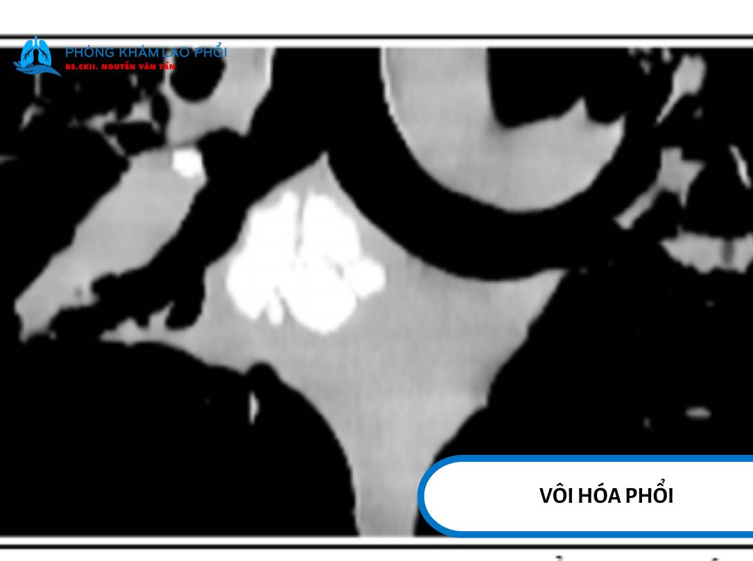 Sỏi phế quản (vôi hóa)