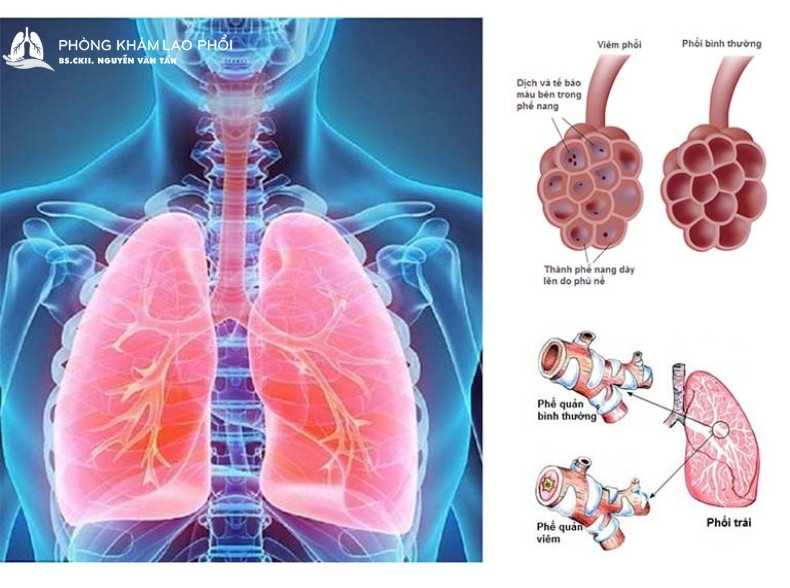 Giãn phế quản là một trong những di chứng sau khi điều trị lao phổi