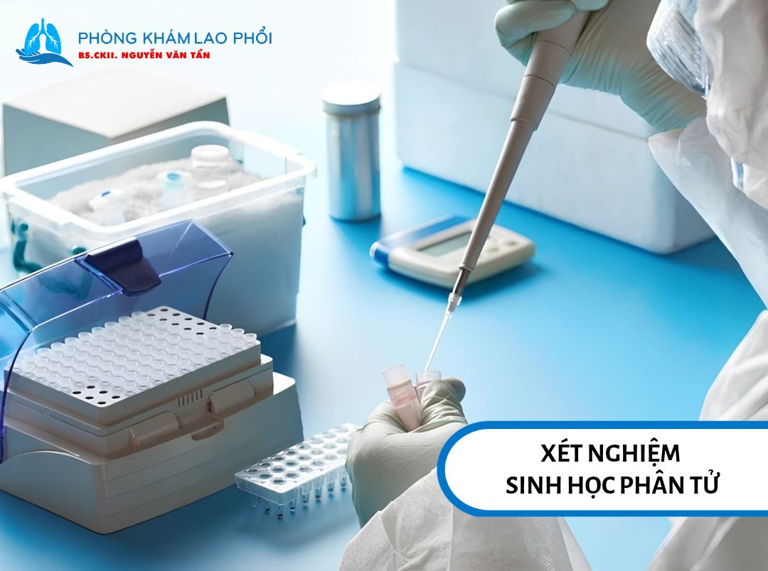 Xét nghiệm sinh học phân tử giúp phát hiện vi khuẩn lao và khả năng kháng thuốc Rifampicin