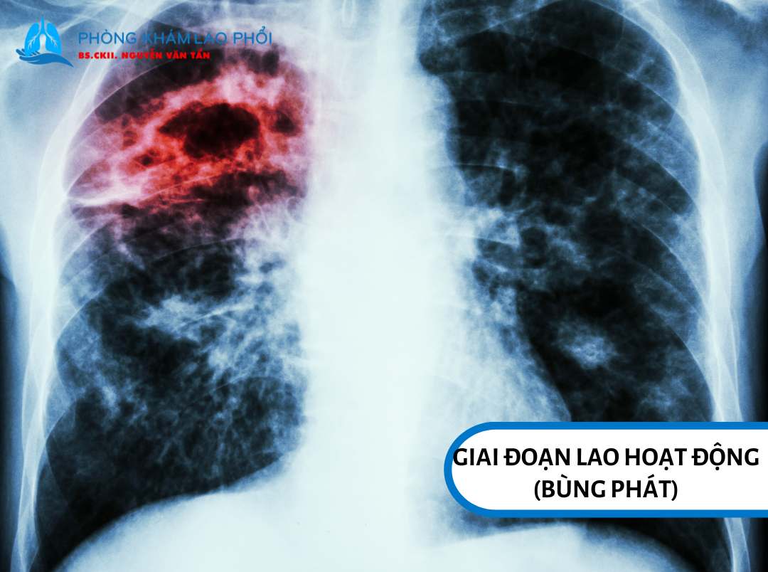 Giai đoạn bùng phát cho thấy các dấu hiệu lao rõ rệt hơn