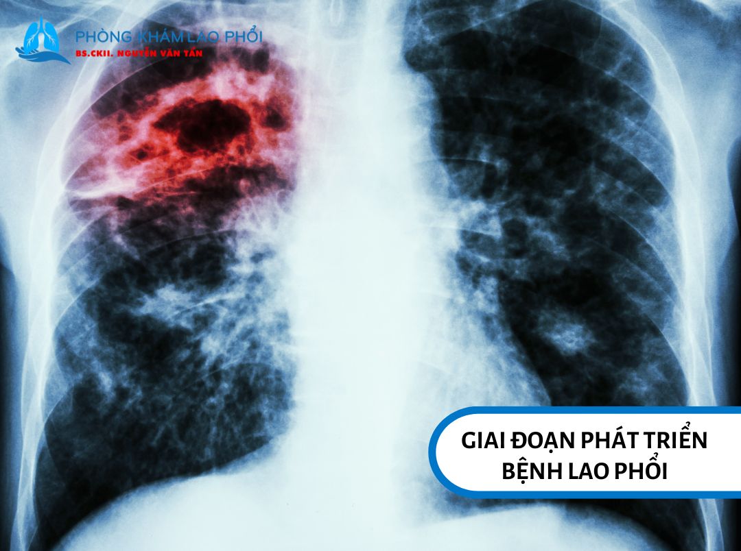 Mycobacterium tuberculosis lây truyền chủ yếu qua đường hô hấp
