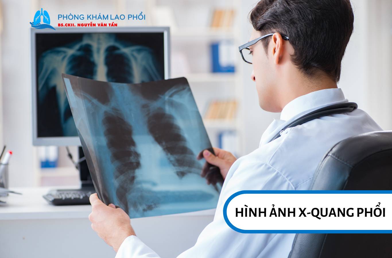 X-quang phổi giúp bác sĩ đánh giá tổn thương do lao