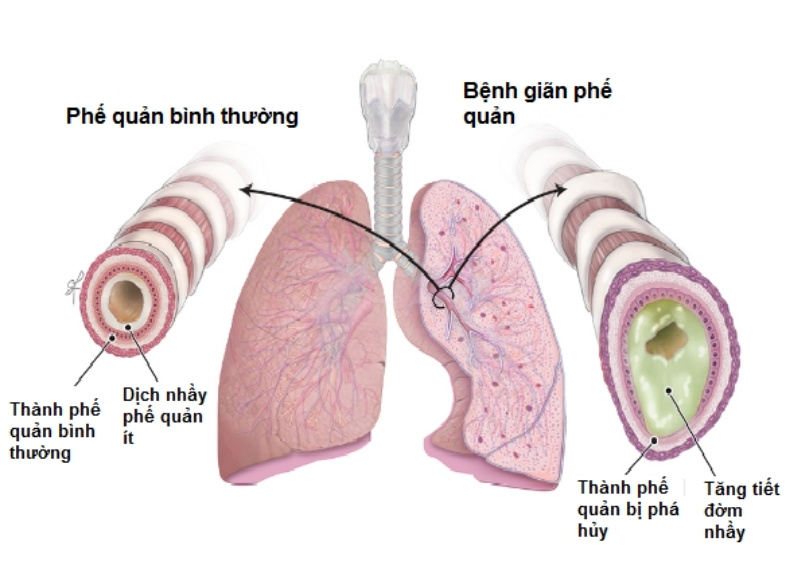 Giãn phế quản là tình trạng giãn không hồi phục 1 phần của cây phế nang