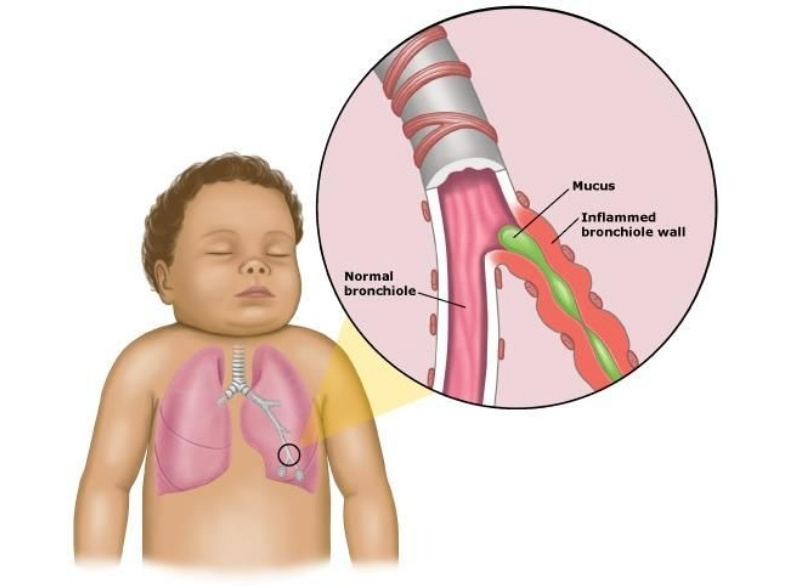 Những đối tượng có nguy cơ bị giãn phế quản