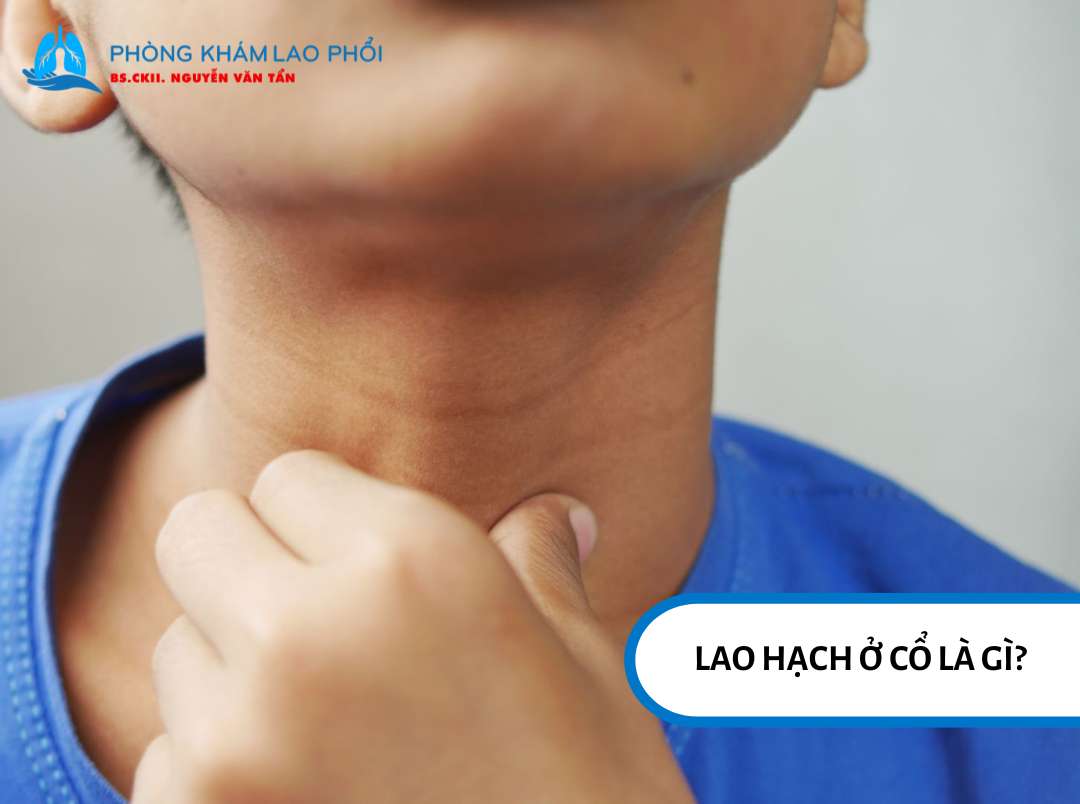 Lao hạch cổ là dạng phổ biến nhất của lao ngoại phổi