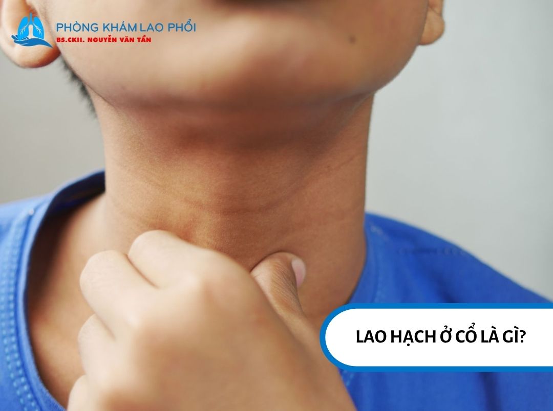 Lao hạch cổ là dạng phổ biến nhất của lao ngoại phổi