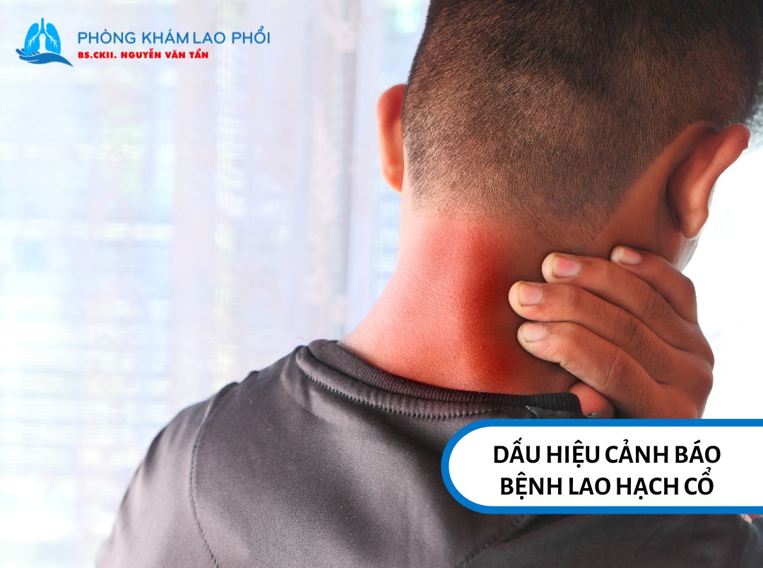 Dấu hiệu cảnh báo bệnh lao hạch cổ bạn không nên chủ quan