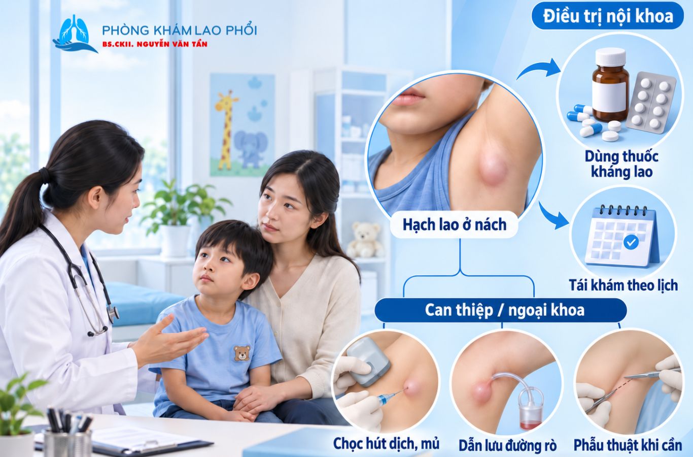 Điều trị lao hạch nách ở trẻ bằng thuốc và can thiệp khi cần thiết