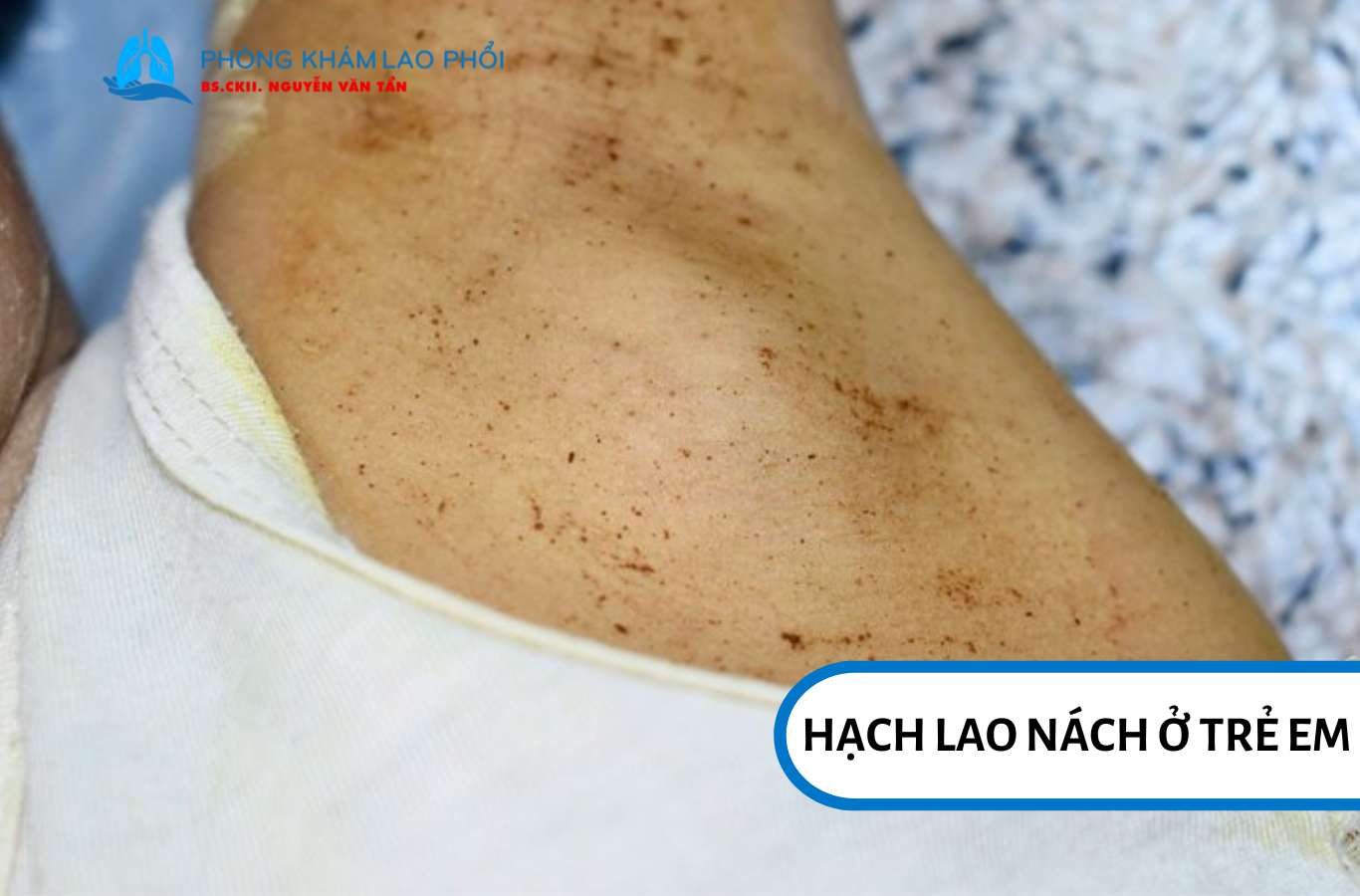 Hạch lao ở nách trẻ em