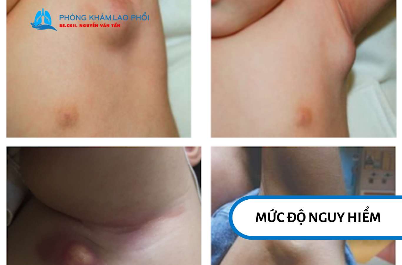 Nếu không điều trị kịp thời, hạch lao ở nách trẻ em có thể gây nhiễm trùng thứ phát