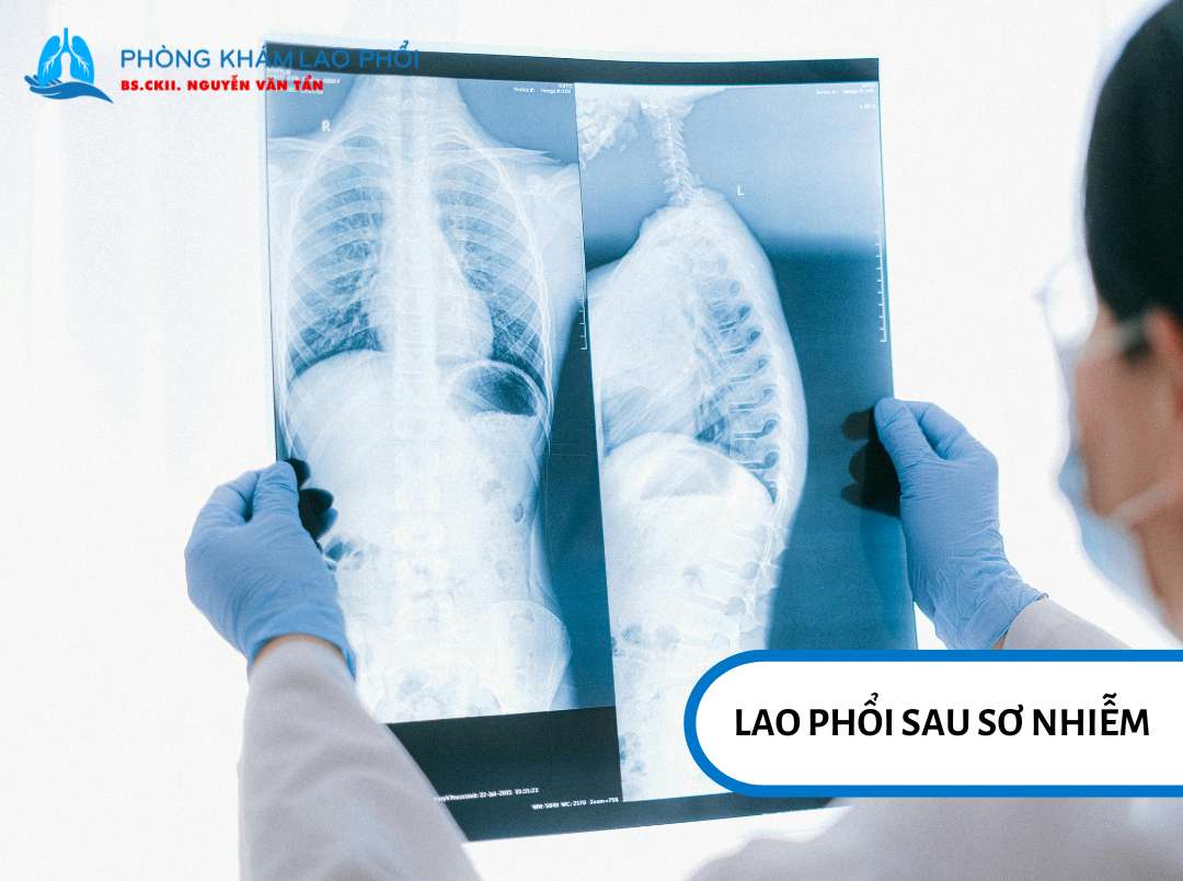 Chụp x-quang để chẩn đoán bệnh lao phổi dạng sơ nhiễm 