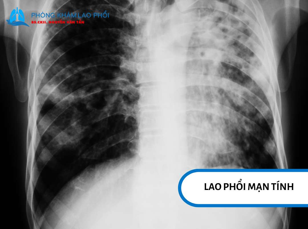 Lao phổi mạn tính là giai đoạn kéo dài của bệnh lao phổi