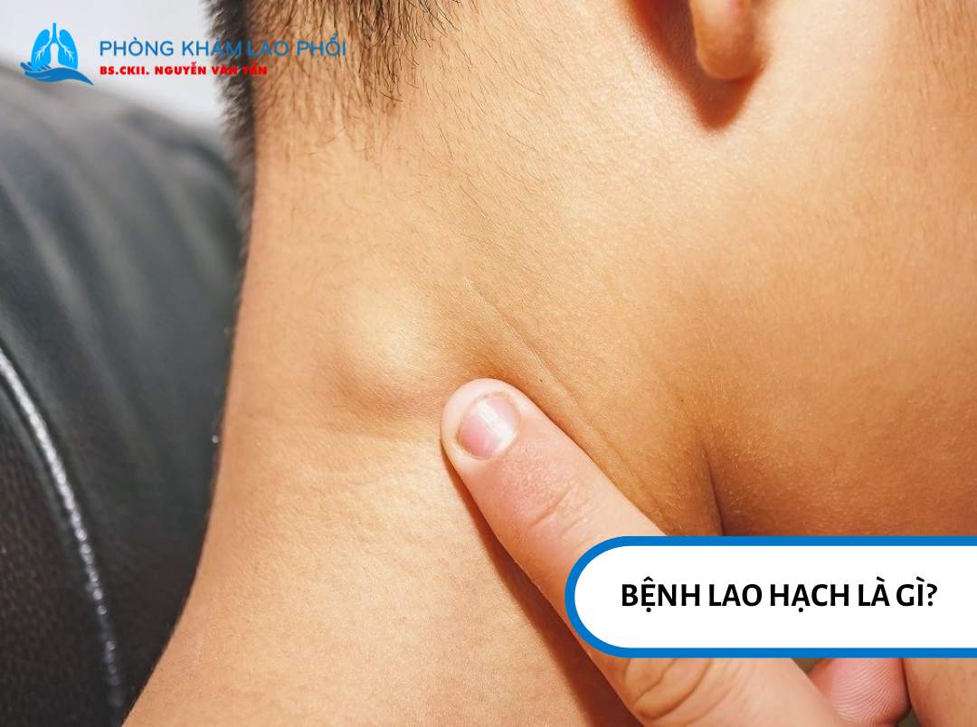 Bệnh lao hạch là tình trạng vi khuẩn lao tấn công vào các hạch bạch huyết, gây viêm và sưng