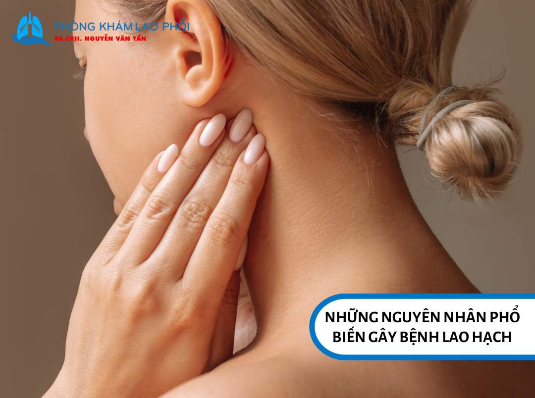 Bệnh lao hạch chủ yếu do vi khuẩn Mycobacterium tuberculosis gây ra